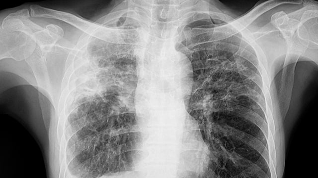 Chest x ray of the patient with lungs tuberculosis 