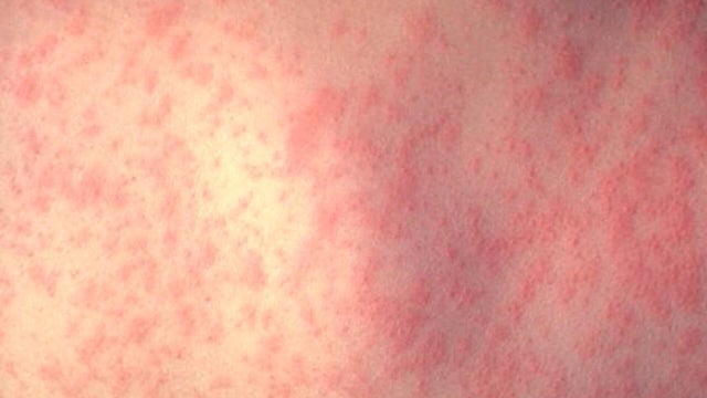 measles.jpg 
