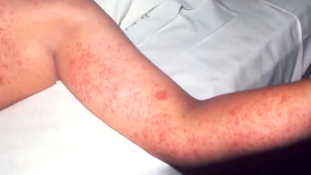 measles-0409.png 